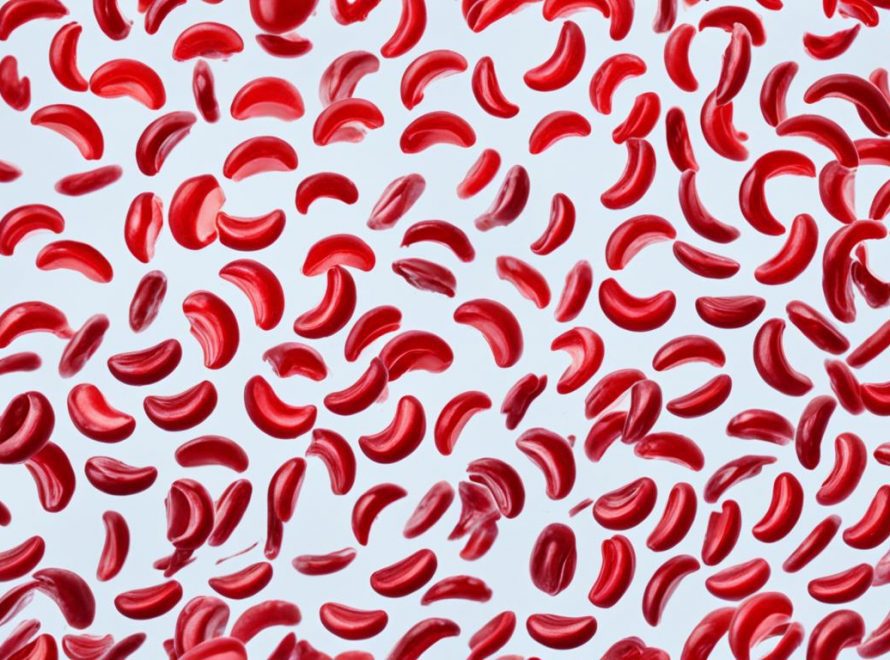 Anemia sickle cell