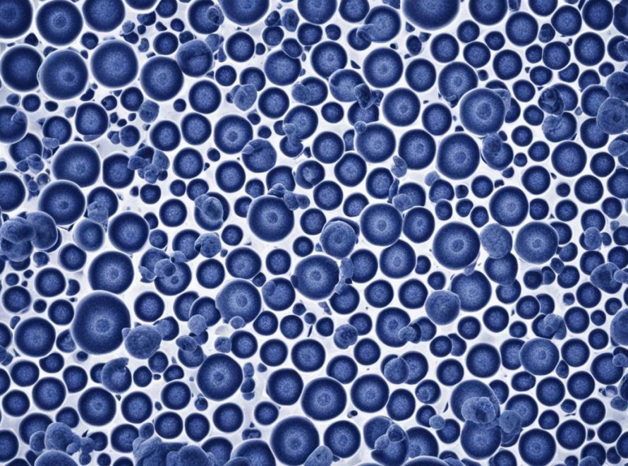 Chronic lymphocytic leukemia